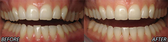 Before and After Invisalign Patient