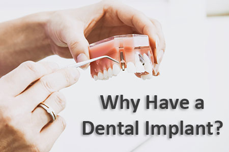 Why have a Dental Implant, Complete Dental Health