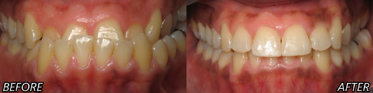 Smile Makeover and Reconstruction in Hillcrest San Diego